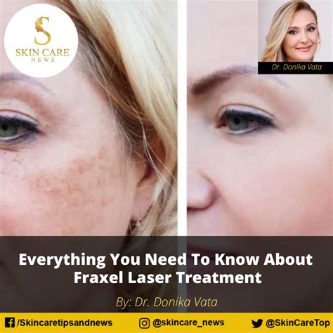 Fraxel Laser Treatments Singapore: 5 Things You Must Know [2024 ].